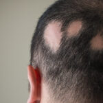 alopecia areata treatment