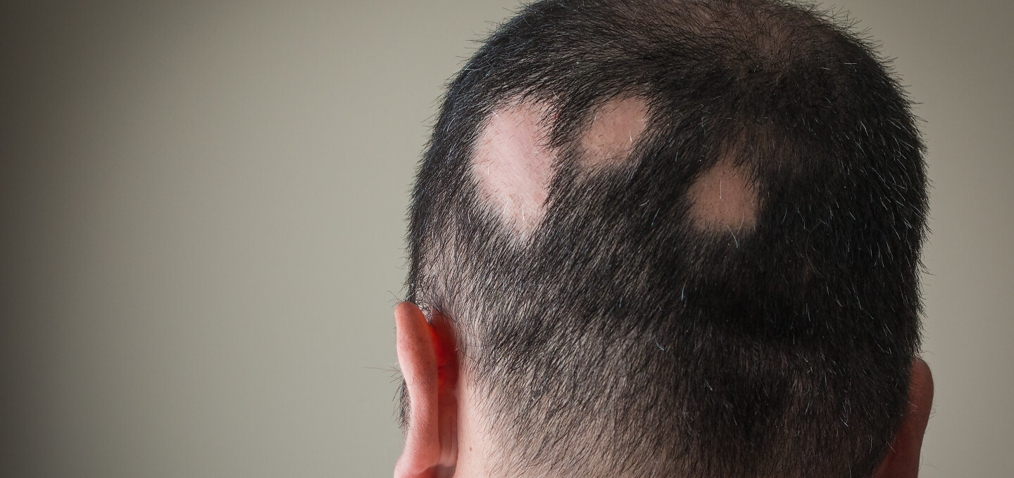 alopecia areata treatment