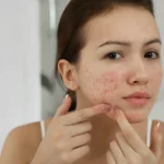 how to remove pimples