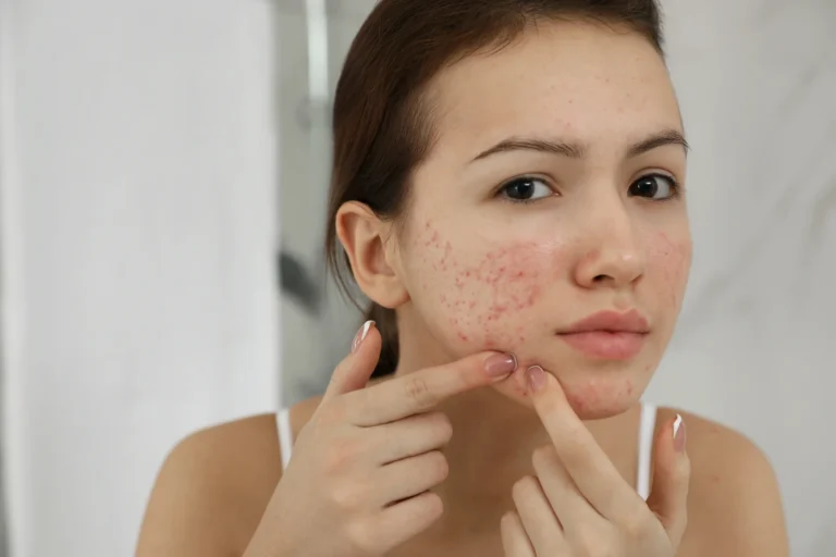 how to remove pimples